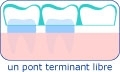 Bridge dentaire en Hongrie