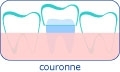 Couronne dentaire en Hongrie